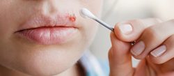 What are cold sores and how to relieve them